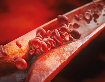 Blut Arterie verstopft